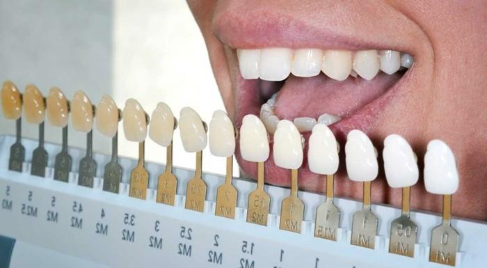 idées de blanchiment des dents méthodes de blanchiment des dents blanches échelle de luminosité éclaircissante